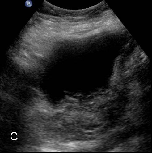 ureterale