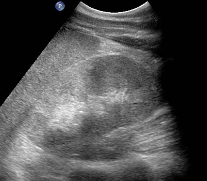 Volume Renale Aumentato più difficile anche stabilire l etiologia.