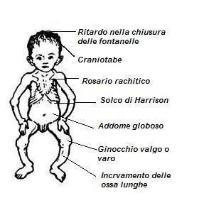 Esempio clinico: il rachitismo Il rachitismo è una malattia tipica dell'età pediatrica ed è