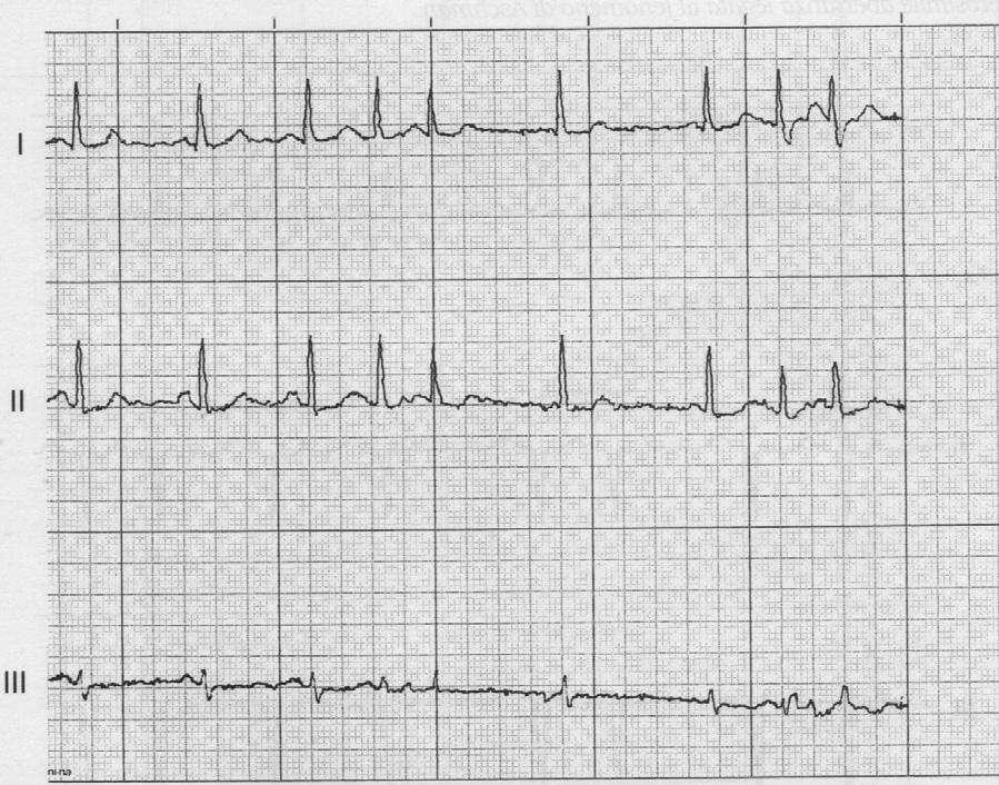 BLOCCO DI BRANCA INTERMITTENTE Figura 1. Ritmo sinusale interrotto da coppie di extrasistoli atriali.