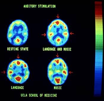 Tecniche di brain imaging: PET (Tomografia a Emissione di Positroni) Aree attivate del cervello: bruciano piu energia (ossigeno e glucosio) PET (Positron Emission Topography)= immagine funzionale del