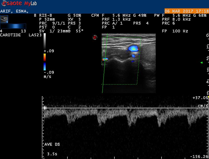 Controllo 5 mesi dopo Arteria Vertebrale destra con flusso di normale morfologia ed