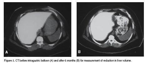 Effetti anatomici del calo di peso 2 (dopo 6 mesi di trattamento con palloncino intragastrico) Measurement of liver volume