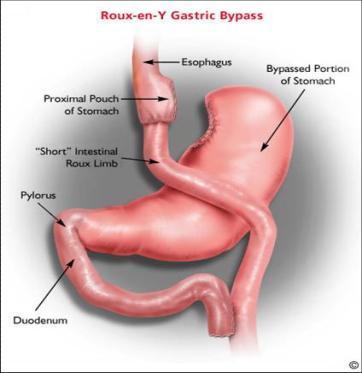 BYPASS GASTRICO Vantaggi: Buon calo ponderale. Eseguibile anche in laparoscopia. Buon trattamento del Diabete Mellito. Svantaggi: Difficoltà di studio dello stomaco escluso.