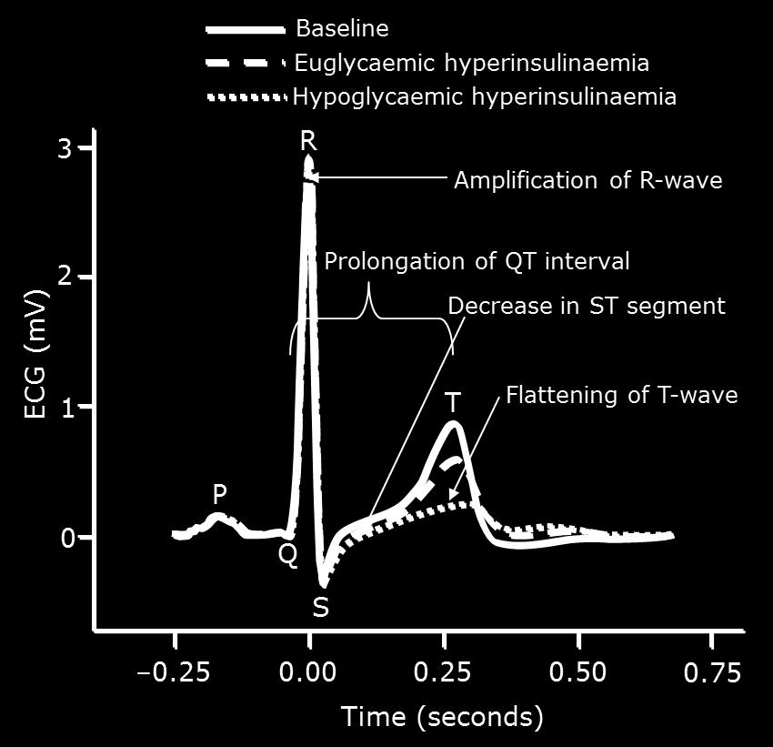ripolarizzazione ventricolare onda-r: amplificazione
