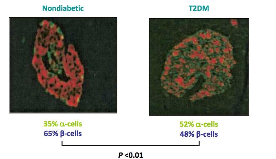 DMT2: patologia Nel DMT2 le insule mostrano incremento del