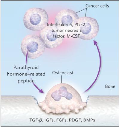 LE METASTASI OSTEOLITICHE DA CARCINOMA MAMMARIO La distruzione ossea è mediata dagli osteoclasti Le cellule tumorali producono fattori che inducono il reclutamento e l attivazione osteoclastica