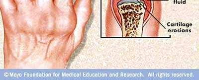 RHEUMATOID ARTHRITIS Chronic, autoimmune disease characterized by: Severe joint