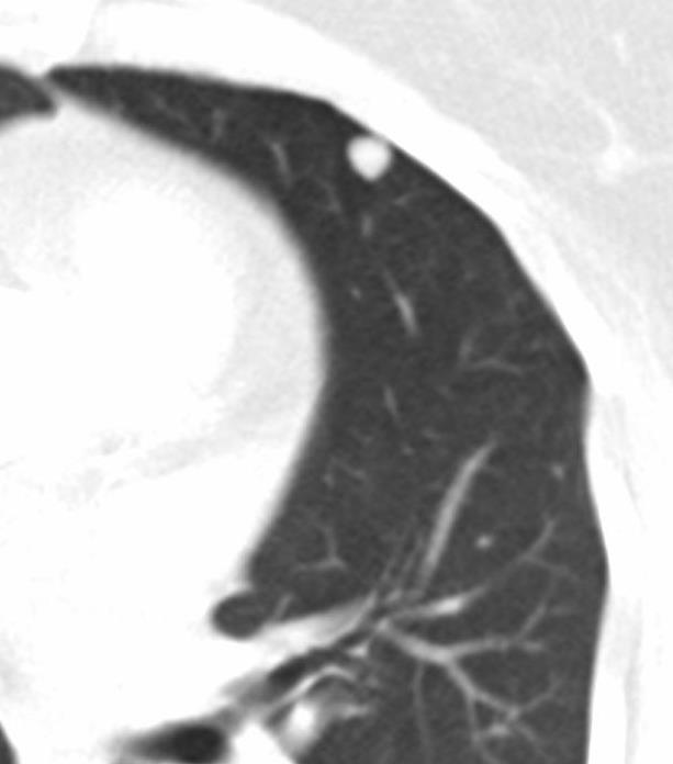 bronchiali (60% e 55% versus 6%). Enfisema solo nel 5% degli anziani non fumatori. Non correlazione con i test funzionali.