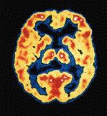 BRAIN METABOLISM IN ALZHEIMER'S S DISEASE PET scans