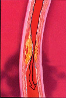 Il restringimento o la chiusura della coronaria avviene a causa della formazione di un incrostazione (detta placca o ateroma) sulla parete interna del vaso, un processo definito aterosclerosi.
