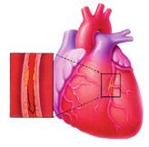 Peraltro, l aterosclerosi può interessare tutte le arterie e quindi colpire organi differenti dal cuore.