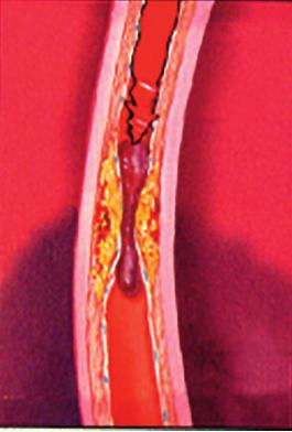 IL FLUSSO SANGUIGNO È COMPLETAMENTE INTERROTTO TESSUTO MUSCOLARE DANNEGGIATO IRREVERSIBILEMENTE Angina pectoris È il primo sintomo che ci segnala che il flusso in una o più coronarie è parzialmente