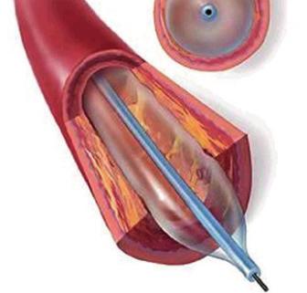 Che cosa succede durante l intervento L angioplastica è una procedura relativamente veloce, che dura circa una o due ore e viene effettuata in un laboratorio di cateterismo cardiaco.