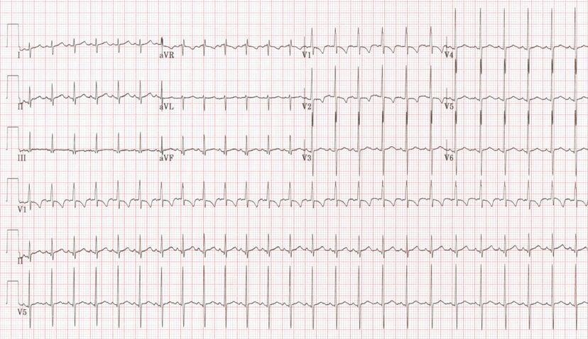 ECG neonato: manca, la variabilità dell RR legata