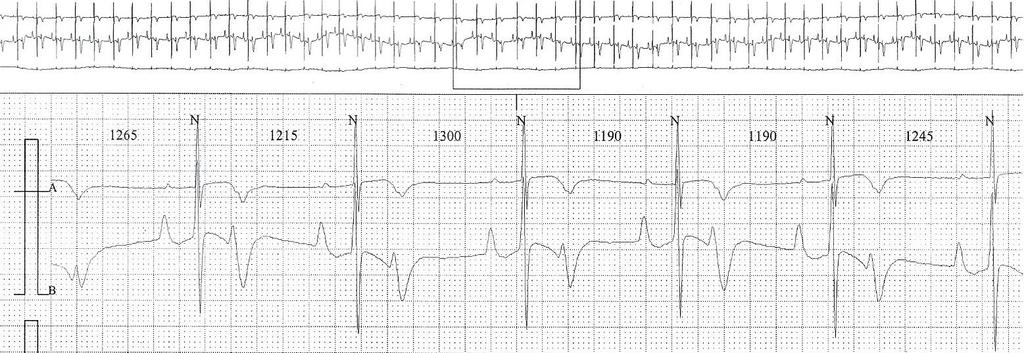 Blocco Di II grado tipo 2:1 Una P su due è bloccata Tipo II Mobitz Caratteristiche Le onde P sono sinusali a frequenza normale Il PR è costante nel battito condotto Diagnosi differenziale Battiti