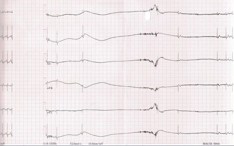 Malattia del nodo del seno rara nel neonato quasi sempre secondaria a cardiochirurgia Caratterizzata da bradicardia sinusale arresto