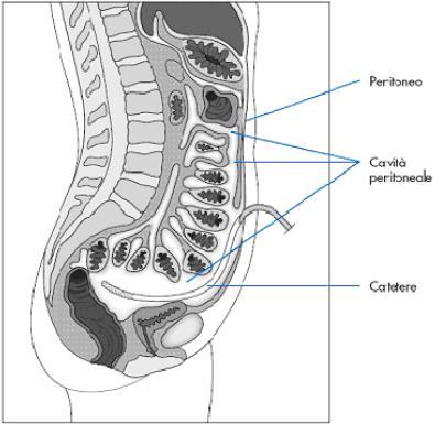 Dialisi Peritoneale Nella dialisi peritoneale il FILTRO è costituito dalla membrana peritoneale o