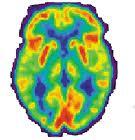 Item Diagnosi/SubItem PET Selezionato 1 studio La PET come studio dell attivazione del metabolismo cerebrale nei pazienti con SV e SMC, pur evidenziando pattern di attivazione diversi, a causa della