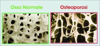 OSTEOPOROSI Malattia dello scheletro caratterizzata da: - una diminuita massa ossea -da un