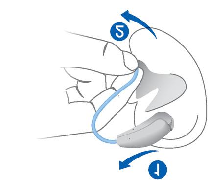 Rimozione di un apparecchio acustico XXSollevare l'apparecchio acustico e passarlo sopra la parte superiore dell'orecchio ➊.