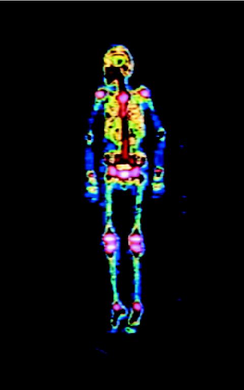 Radioisotopi in Medicina Produzione di laboratorio di 99 Mo 98 Mo + 1 n 99 Mo 42 0 42 Produzione commerciale di 99 Mo 235 U + 1 n 99 Mo +