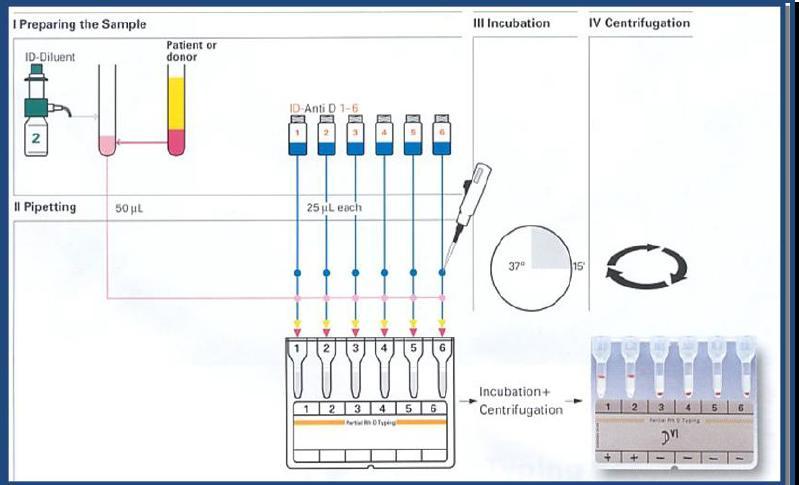 Figura 4: Si introducono in ogni camera delle colonne 50 µl di una sospensione allo 0,8% di eritrociti (in tampone LISS) del paziente e 25 µl di ciascun anticorpo monoclonale anti-d.