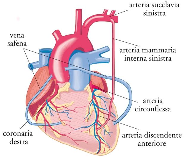 CABG = coronary artery bypass
