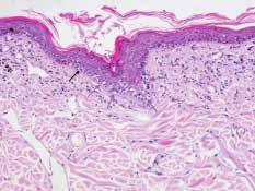 Lesione dell interfaccia caratterizzata da degenerazione idropica (frecce rosa) e apoptosi (freccia nera) dei cheratinociti basali nella zona infundibolare (E-E, medio ingrandimento).