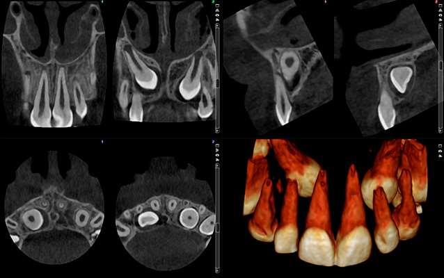 Immagini a ultra basso dosaggio Caso ortodontico Planmeca ProMax 3D Max - FOV Ø