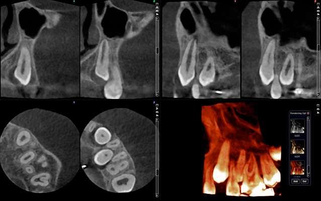 Immagini a ultra basso dosaggio Caso ortodontico Planmeca ProMax 3D Max - FOV Ø