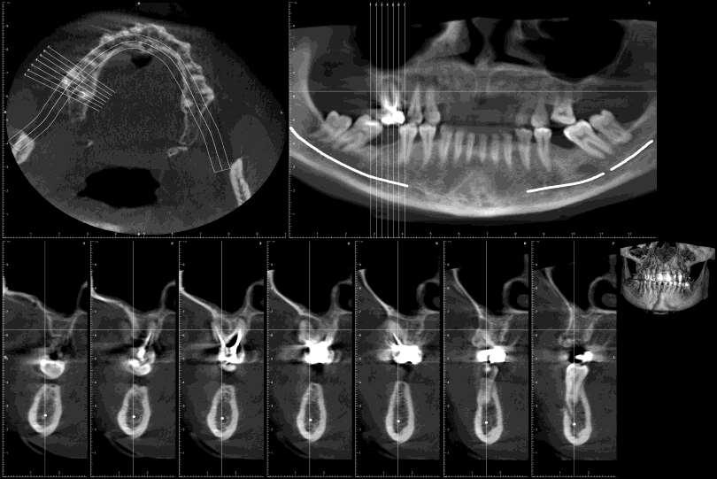 Lesione apicale di 16