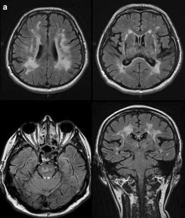 Utilità del neuroimaging: casi emblematici (II) CADASIL