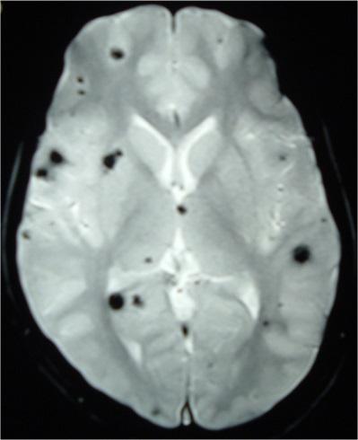 Subcortical Infarcts and Leukoencephalopathy)