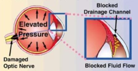 Iniziare subito terapia steroidea Palpazione e doppler arteria temporale, biopsia Glaucoma ad angolo chiuso In questi casi il dolore è oculare.