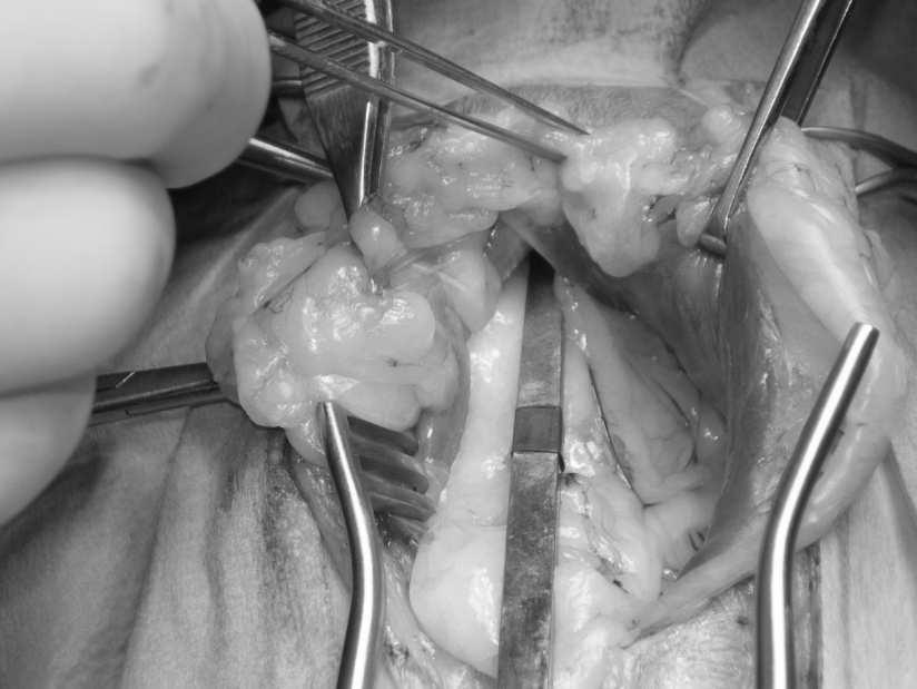 Figura 4: Aspetto operatorio contiguità anatomica tra pericardio e cupola diaframmatica, sia della presenza un pattern gassoso tipico della presenza di anse intestinali.