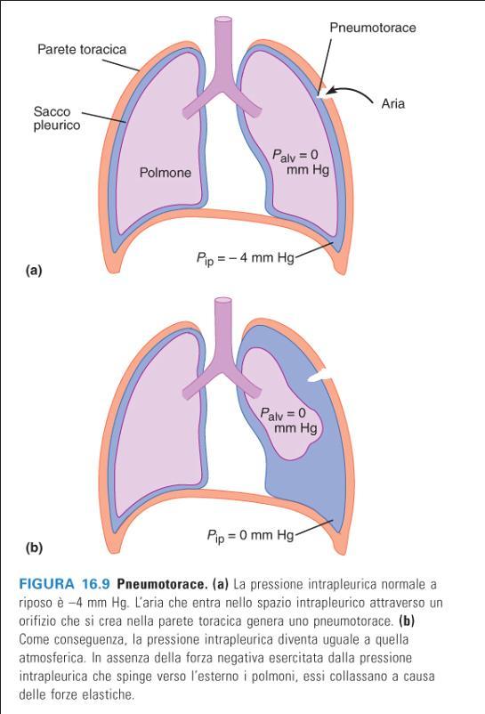 pneumotorace (aria nello spazio intrapleurico) Per poter mantenere una pressione intrapleurica negativa è necessario che il sacco intrapleurico sia a tenuta d aria.