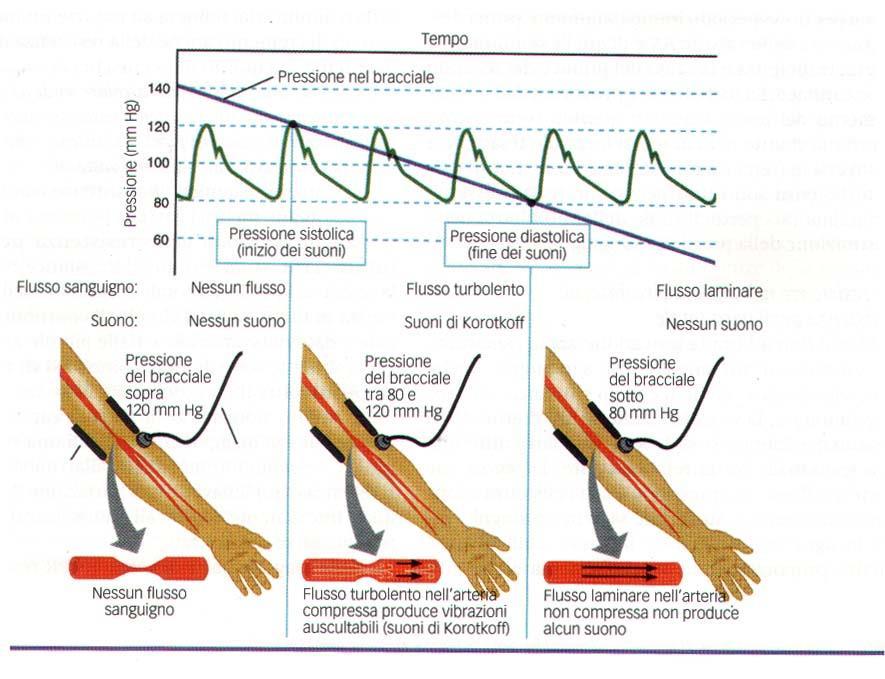 MISURAZIONE DELLA PRESSIONE SANGUIGNA si basa sul fenomeno della turbolenza e del rumore che la accompagna.