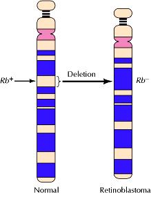 Geni oncosoppressori: Rb Molti retinoblastomi hanno delezioni del locus cromosomico (13q14) che contiene il gene Rb.