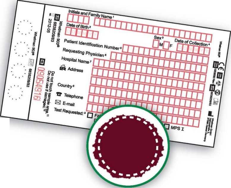 Diagnosi di laboratorio della malattia di Gaucher Studio delle alterazioni genetiche ed enzimatiche PROCEDURA PER L INVIO DEI DBS (Dried Blood Spot) Utilizzare un DBS uguale o simile all immagine e