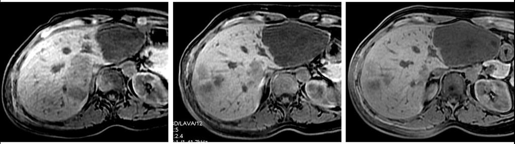 riduzione del volume dell FNH dopo la somministrazione di mdc (acido gadoxetico) in fase arteriosa ed eseguite al momento della diagnosi (a), due anni (b) e tre