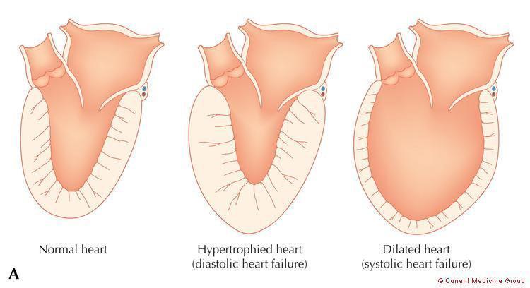 Pathophysiology of heart failure with