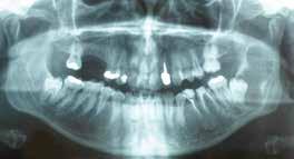 In alto a destra: TC Dental Scan del precedente quadro. A destra: RX OPT di cisti odontogena che interessa angolo e ramo mandibolare con elemento 3.