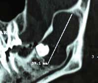 Tumori odontogeni: alcuni tumori odontogeni, come l ameloblastoma, possono avere origine dagli elementi dentali inclusi. Problematiche ortodontiche: affollamento dentario.