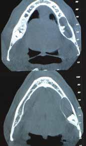 MANUALE DI CHIRURGIA MAXILLO-FACCIALE In ordine decrescente interessano: Terzi molari inferiori Canini mascellari Terzi molari superiori Premolari inferiori.