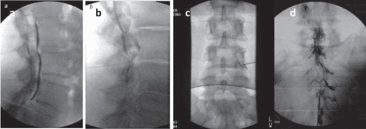 Ricerca e clinica Imaging radiologico nel trattamento del dolore vertebrale Il dolore cervicale, lombare e radicolare rappresenta tipicamente un difficile impegno diagnostico dato che la patologia