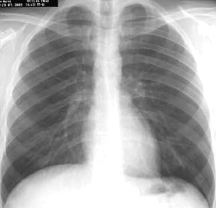 RX positivo in adeguato contesto clinico (febbre elevata, tosse) REFERTAZIONE CORRETTA non necessita di TC RX