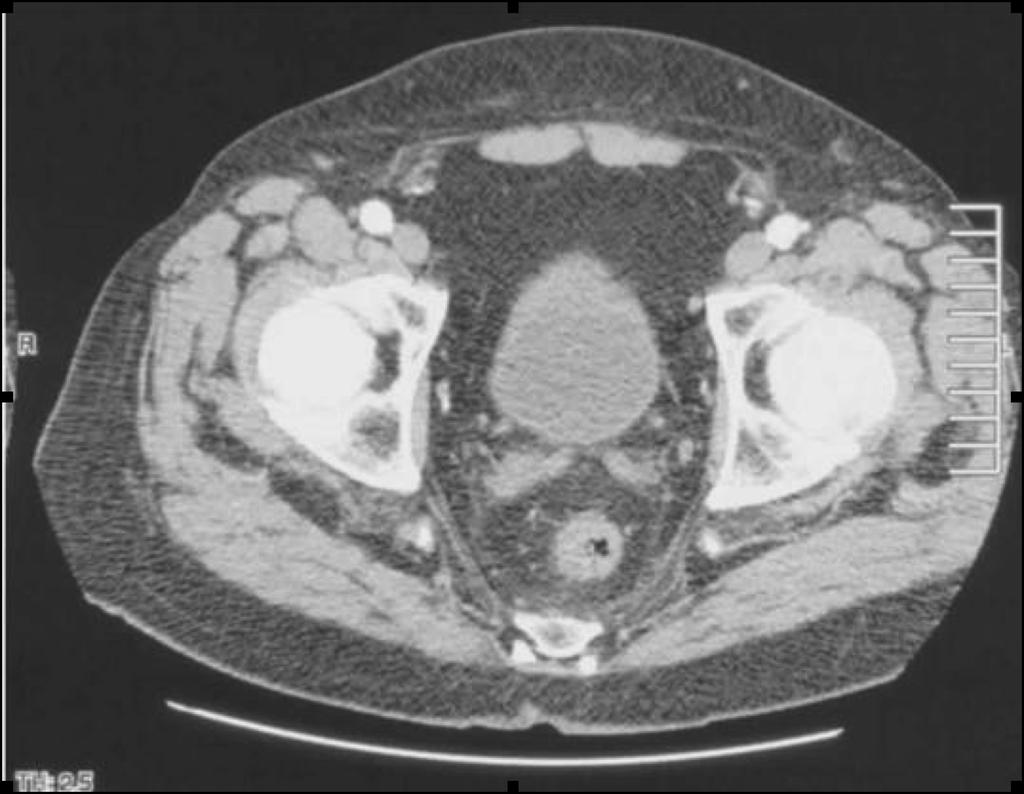 Misurazione dei diametri IE - I diametri delle iliache esterne sulle iagini TC assiali devono essere misurati da parete interna a parete interna per assicurarsi che il sistema di