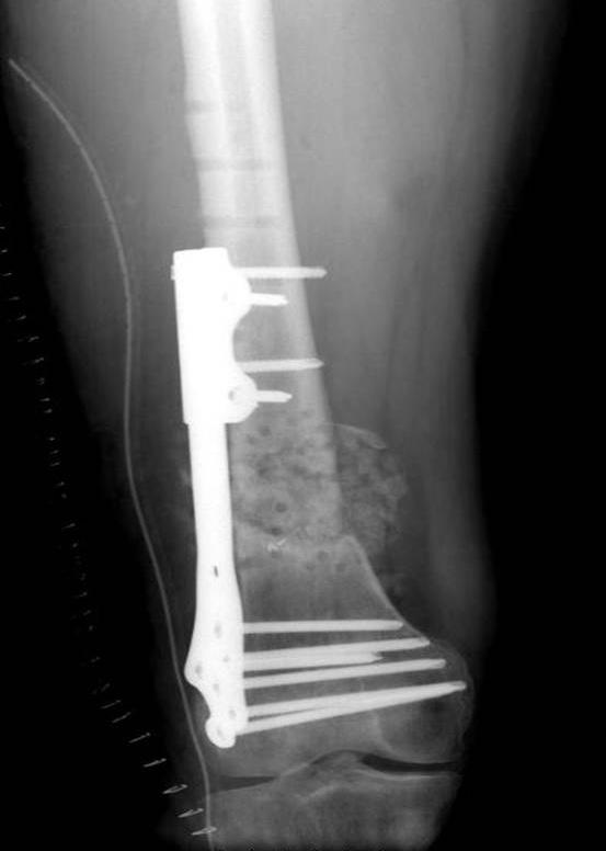 03/11/2009 - Rimozione placca LISS, innesto osseo