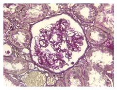 PATHOPHYSIOLOGY OF PROGRESSIVE NEPHROPATHIES Glomerular-capillary hypertension Increased glomerular permeability to